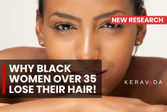 8 Surprising Reasons Why Black Women Over 35 Experience Hair Loss, How to Prevent It